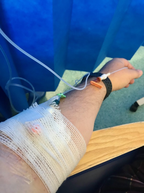 My arm with a cannula — a drip line giving me insulin.