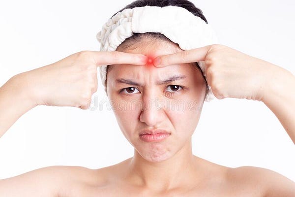 Pimpepopping,acne,scars,whiteheads,blackheads,spots,zits