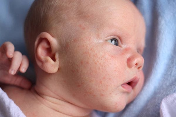 https://www.thebabysmiles.com/how-to-get-rid-of-baby-acne/