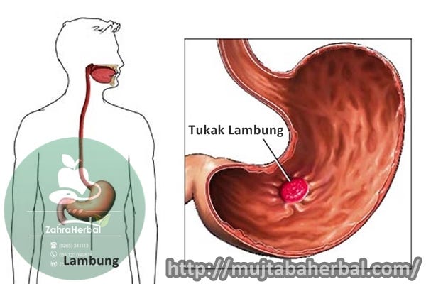 Obat Herbal Untuk Tukak Lambung Yang Ampuh Dan Manjur