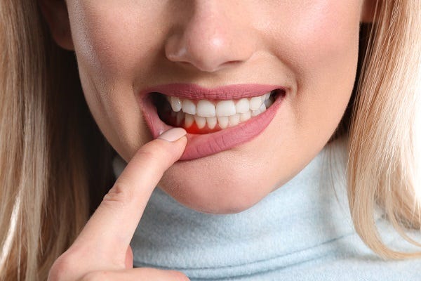 Iqaluit Dental Clinic image of a woman with gum disease.