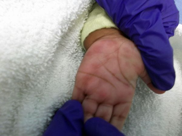 Infant hand with red spots of syphilis rash.