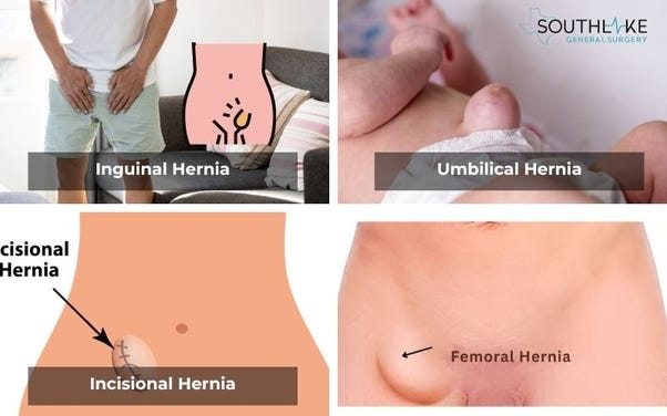 Different types: Inguinal, umbilical, incisional, and femoral hernia.