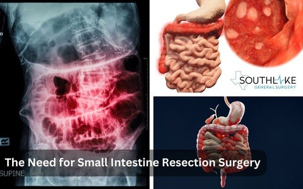 Visual representation of common symptoms necessitating surgery, such as bowel obstruction, severe ulcers, and Crohn’s disease.