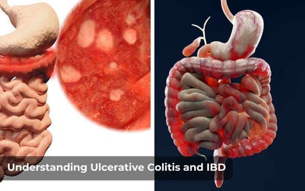 Comparison image of Ulcerative Colitis and Crohn’s Disease highlighting differences.
