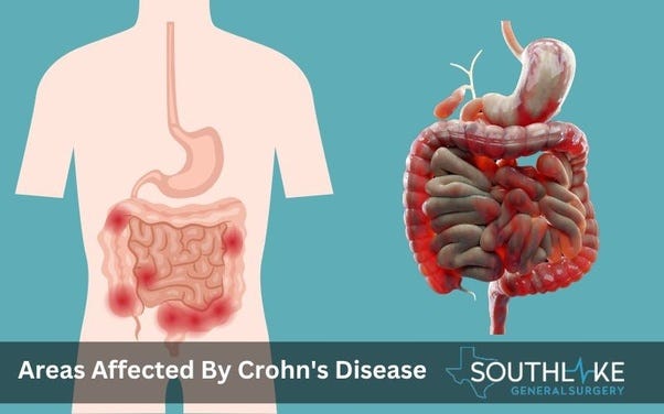 Diagram of the gastrointestinal tract showing areas affected by Crohn’s disease.