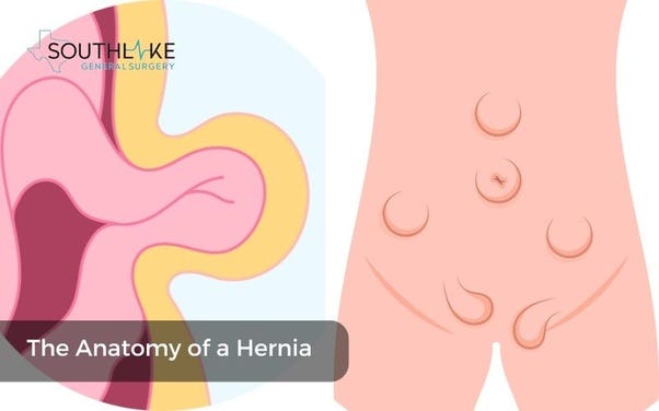 Medical illustration showing the anatomy of a hernia and how it occurs in the abdominal wall.