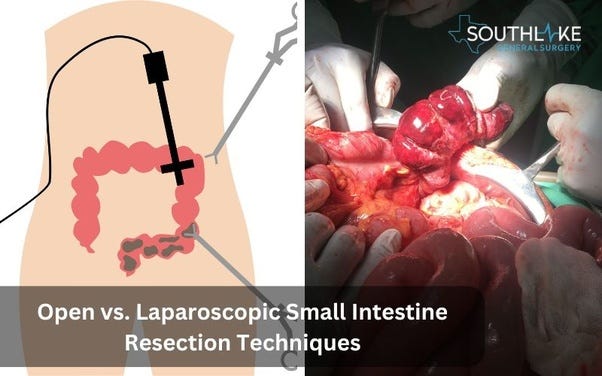 Visual comparison between open resection surgery and laparoscopic resection, illustrating the differences in incision size and recovery benefits.