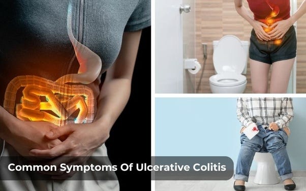 An Illustration of common symptoms of Ulcerative Colitis such as abdominal pain, bloody diarrhea, and rectal bleeding.