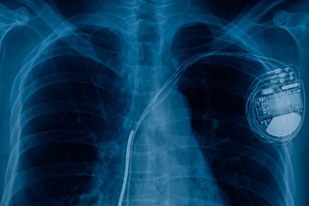 Pacemakers use machine learning to innovate healthcare