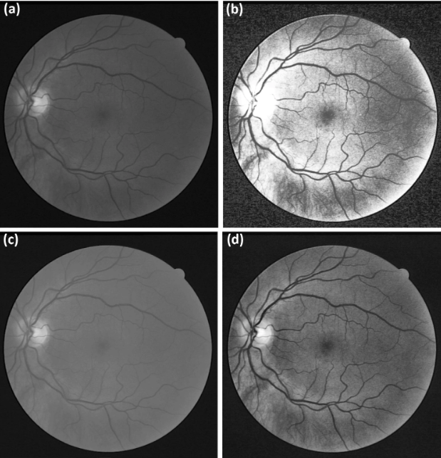 Fundus image enhancement using CLAHE and Weiner filter