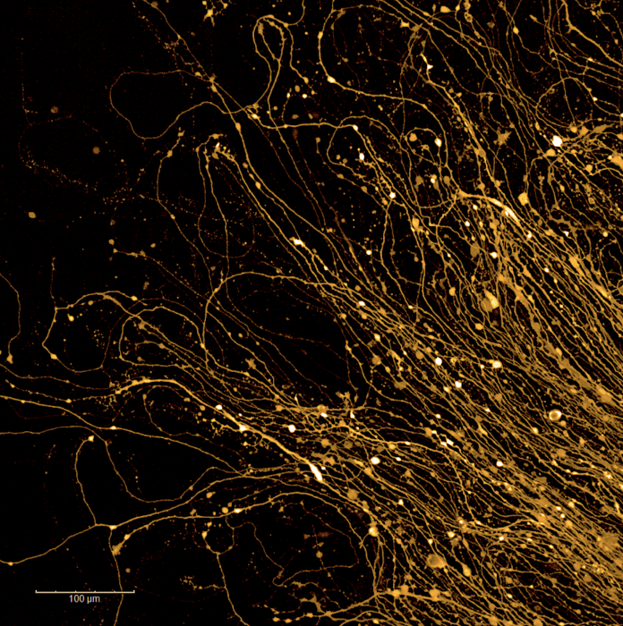 Neurons derived from the stem cells of a Parkinson’s patient. The neurons are colored bright yellow against a black background and resemble thin strands of hair. Image credit: Angelique Di Domenico, PhD