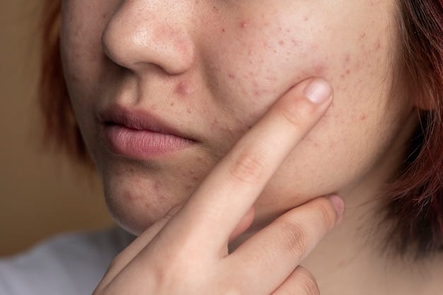 A woman suffering from hormonal acne