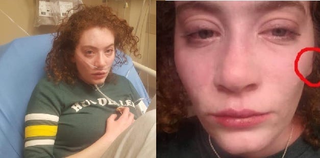 Two photos of the author with facial swelling and hives.