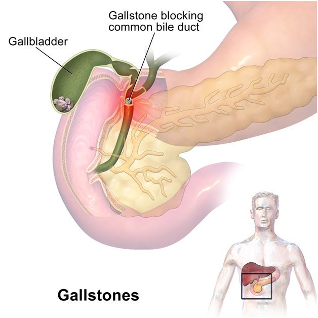 Gallbladder treatment in pune