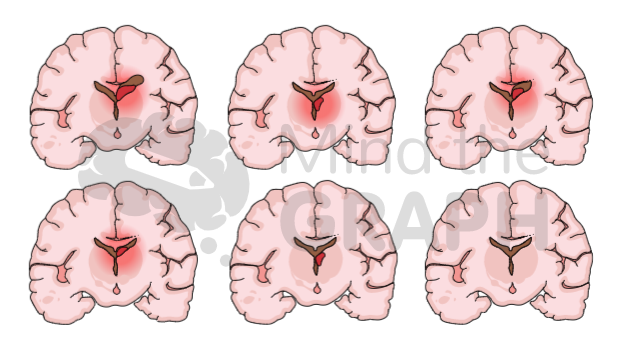 brain_hemmorrhage_scientifc_illustrations