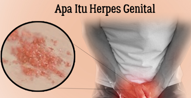 Obat Penyakit Herpes Kelamin Pria Pusat Pengobatan Herpes Medium