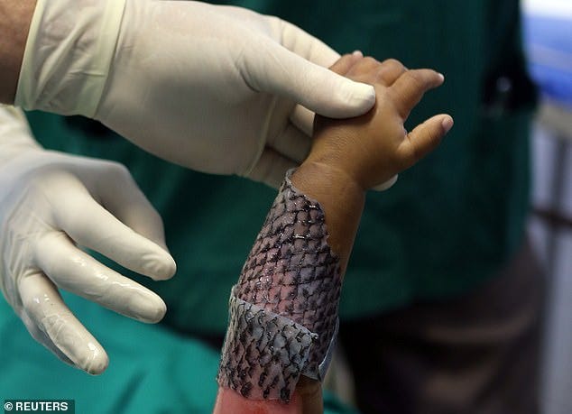 child’s arm with tilapia skin bandage over burn wound