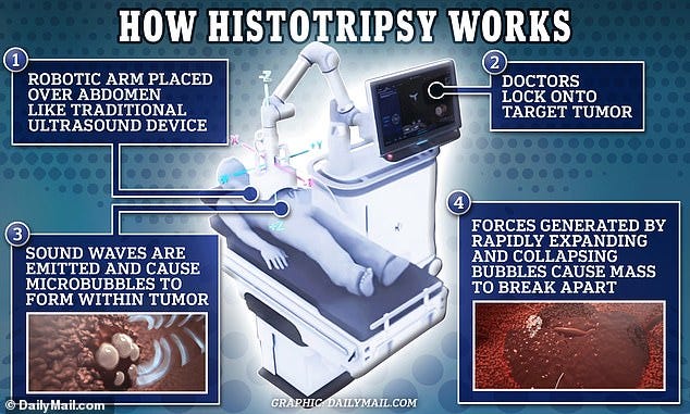 Histotripsy How Sound Waves Cure Cancer