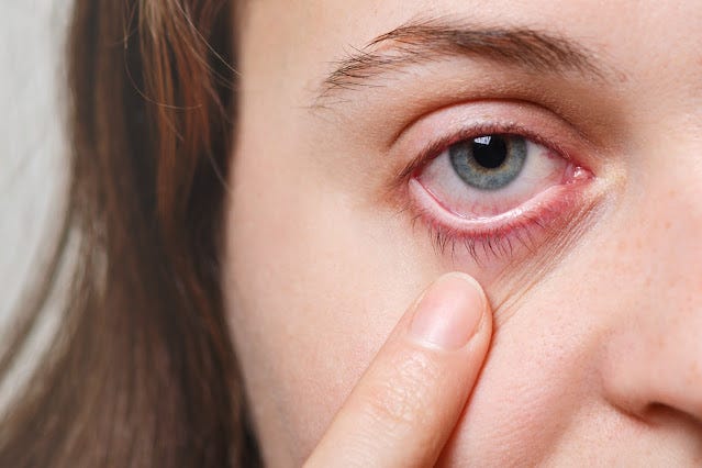 What is Commonly Misdiagnosed as Pink Eye