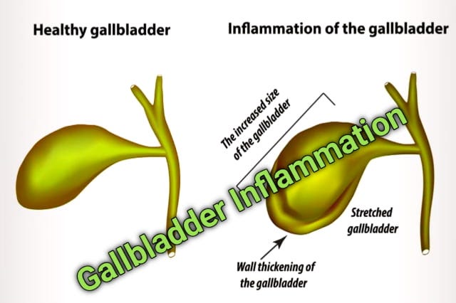gallbladder Inflammation: symptoms, causes, and treatment