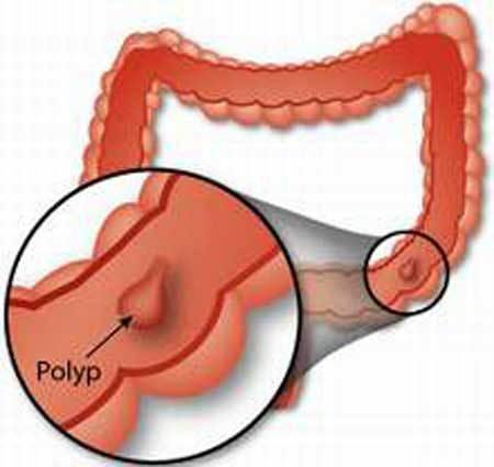 Sức khỏe, đời sống: Một số dấu hiệu polyp hậu môn phổ biến 0*G23wsrdghLLYlAXa