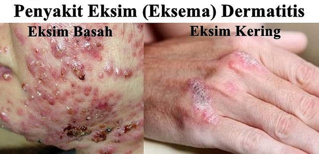 obat untuk eksim numular alami