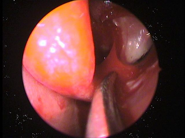 Pus in middle meatus region.