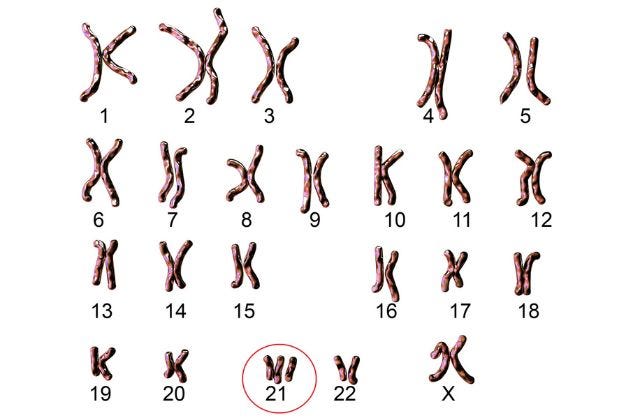 chromosomal example of trisomy 21