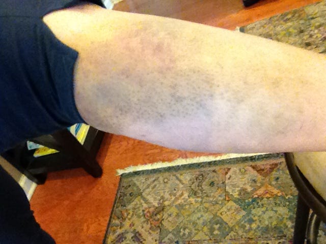 Author’s calf with a huge, swollen bruise