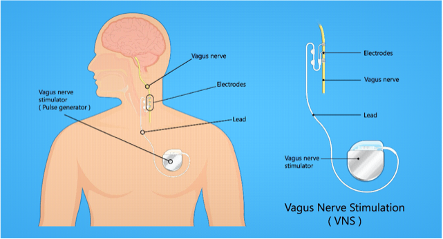 How the VNS is implanted