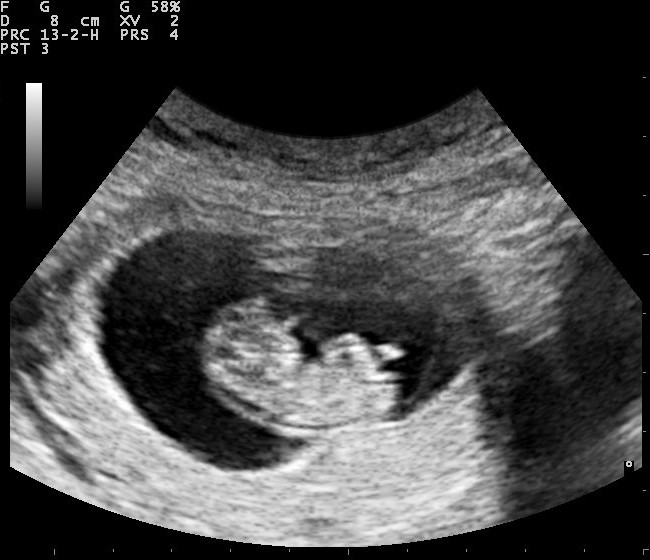 An ultrasound scan.