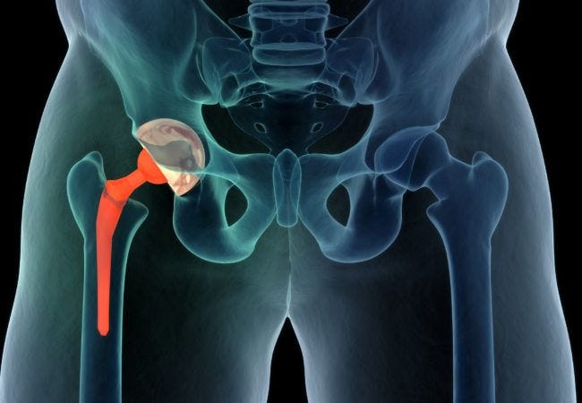 hip replacement treatment in Birchwood