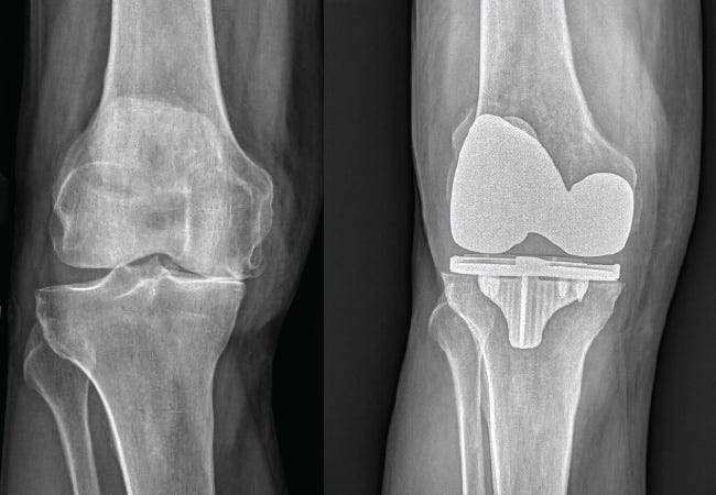 X-ray image of two human knees, one with replacement implant.