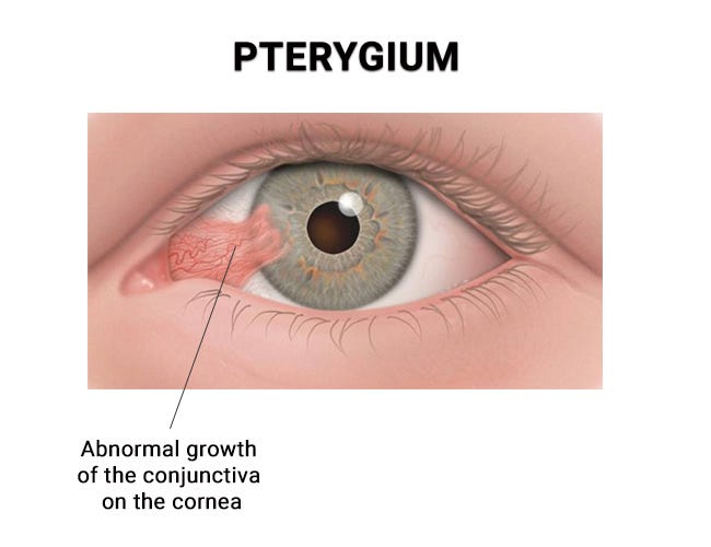 Corneal Pterygium in eye