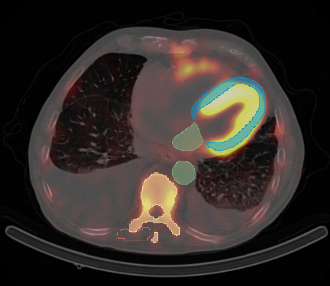 Slice of a CT with segmentations of myocardium, vertebraes and SPECT activation