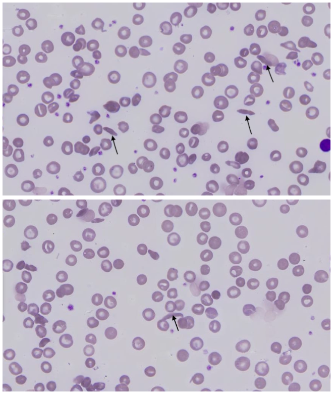 Bent but unbroken: Comprehensive review of sickle cell anemia