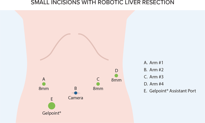 Small incisions with robotic liver resection