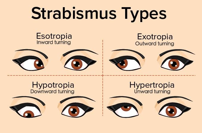 Strabismus and Amblyopia