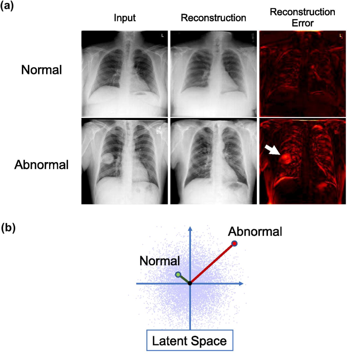 Example of Anomaly Detection inchest X-ray images [4]