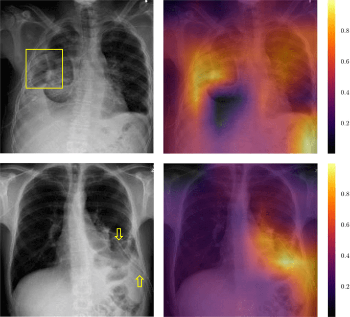 Grad-CAM analysis of image labeled “Pneumothorax” with and without chest drain, Baltruschat et al. 2019.