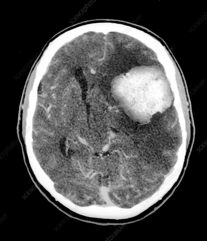 A CT scan of a benign tumor in the brain.