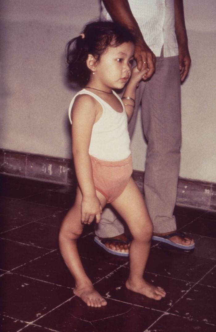 Child with leg deformity from polio (Photo: CDC)