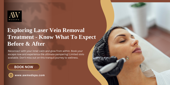 Exploring Laser Vein Removal Treatment — Know What To Expect Before & After