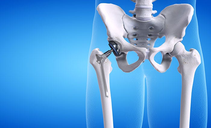 Hip Replacement Surgery in Lincolnshire