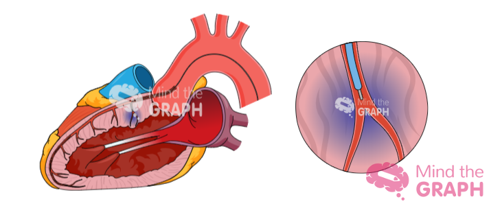 alcohol septal ablation