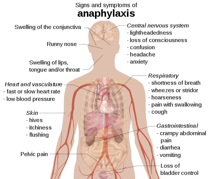 Schematic drawing identifying signs and symptoms of anaphylaxis in the human body.