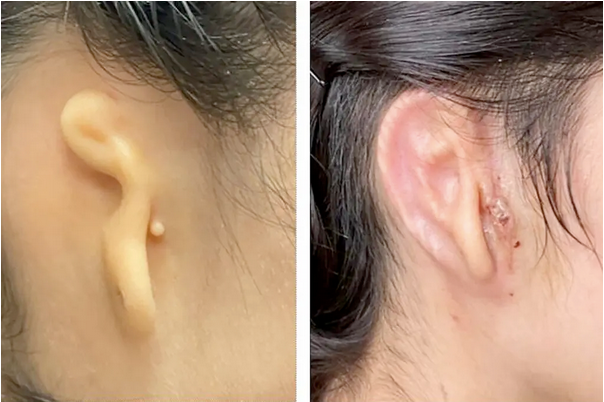 Alexa, the patient, before the surgery, left, and 30 days after the surgery. Image Credit: Dr. Arturo Bonilla, Microtia-Congenital Ear Institute