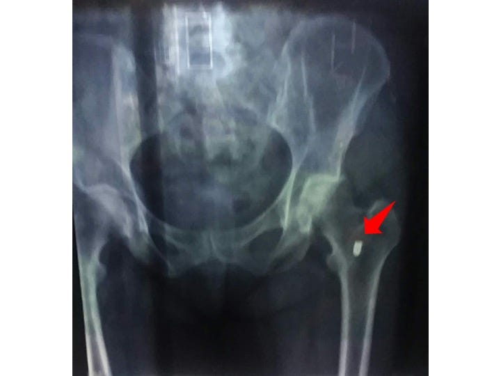 Xray of my R femur, and the bullet