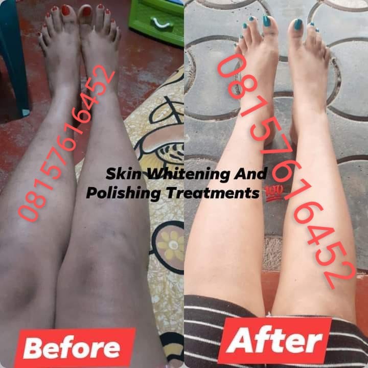 skin whitening and polishing treatments